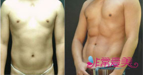 男士腹部吸脂前后对比照